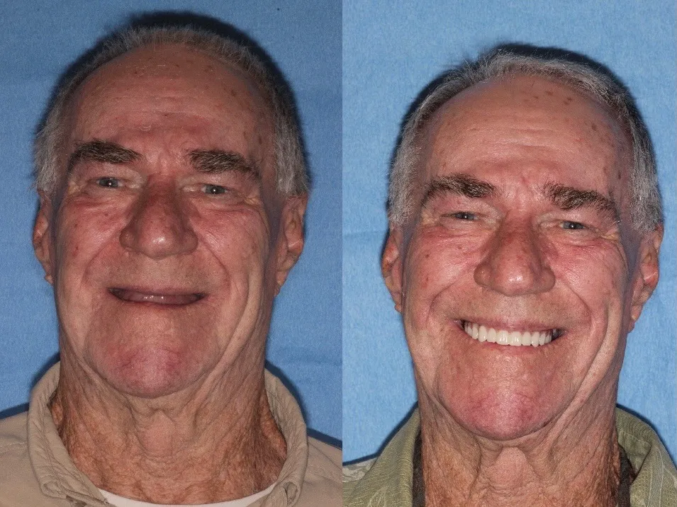 Before & After Dental Implants in Grants Pass OR 
