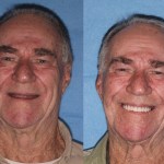Before & After Dental Implants in Grants Pass OR 