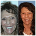 Before & After Dental Implants in Medford OR 