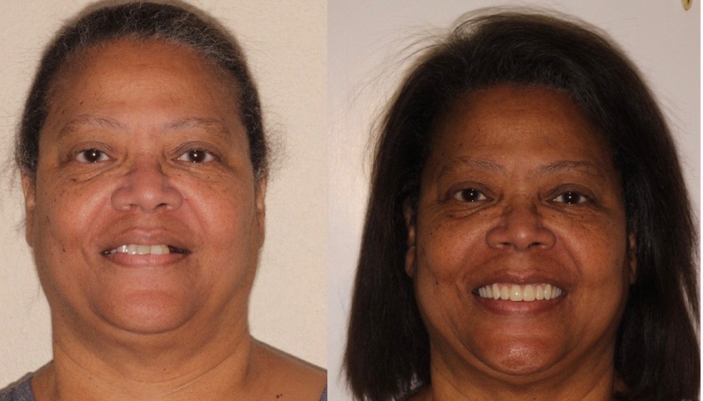 Before & After Dental Implants in Grants Pass OR 