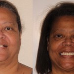 Before & After Dental Implants in Grants Pass OR 
