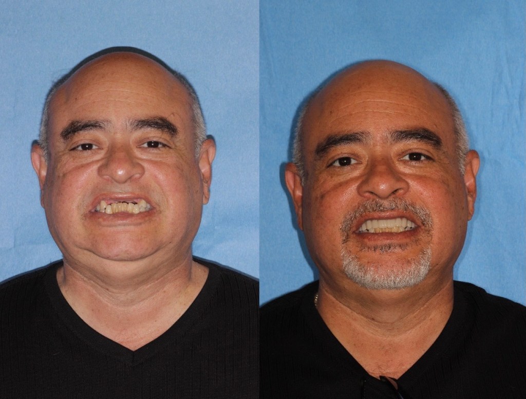 Before & After Dental Implants in Medford OR 