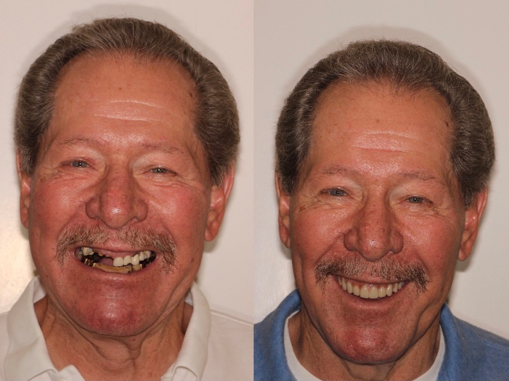 Before & After Dental Implants in Medford OR 