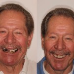 Before & After Dental Implants in Medford OR 
