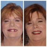 Before & After Dental Implants in Medford OR 