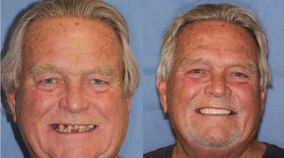 Before & After Dental Implants in Grants Pass OR 