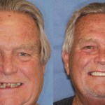 Before & After Dental Implants in Grants Pass OR 