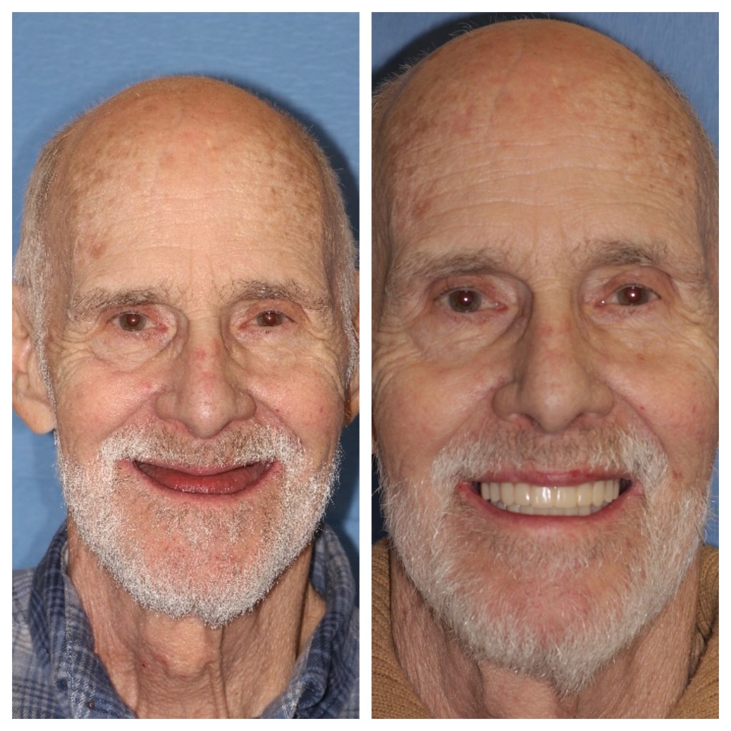 Before & After Dental Implants in Grants Pass OR 