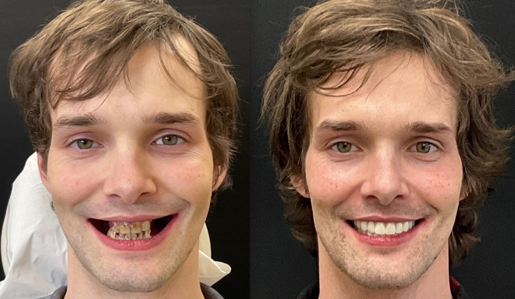 Before & After Dental Implants in Medford OR 