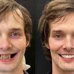 Before & After Dental Implants in Medford OR 